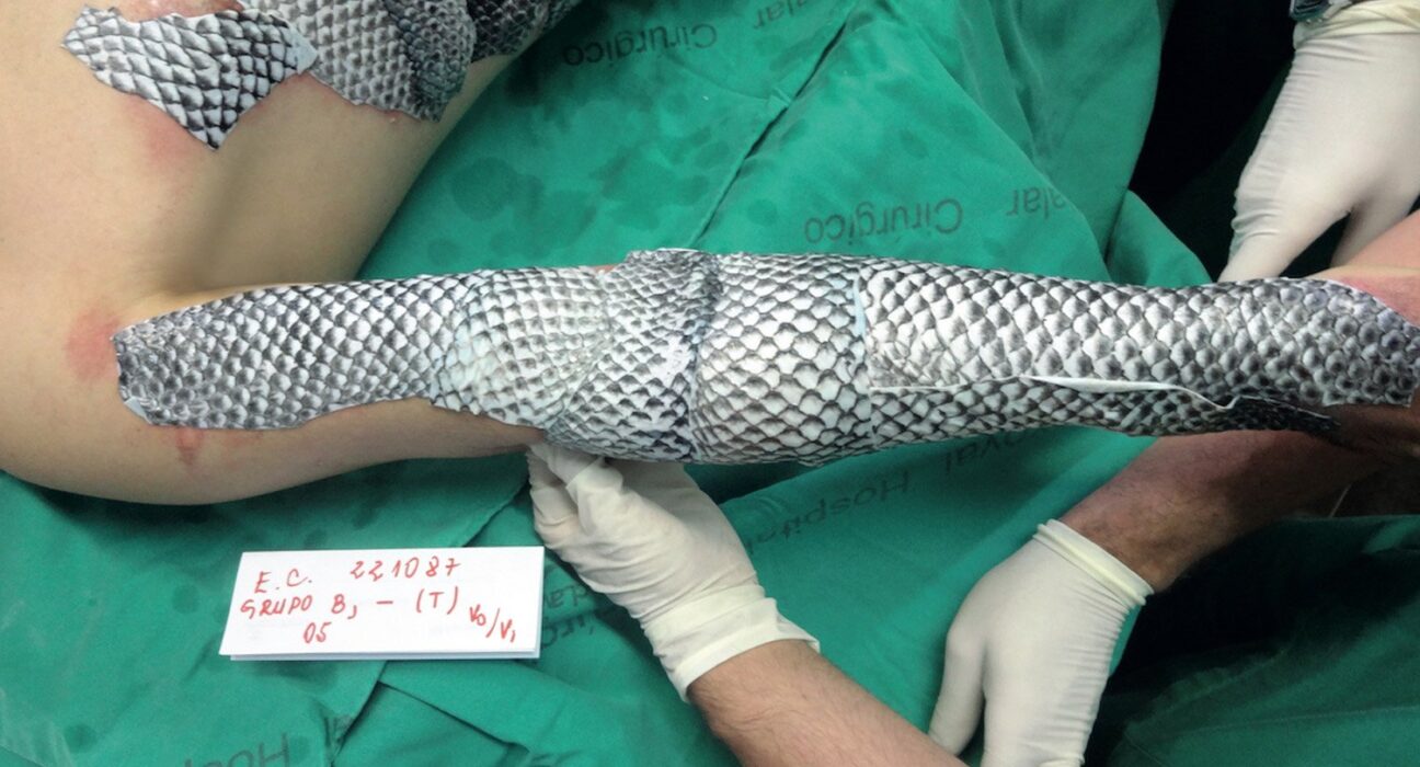 Piel de tilapia para quemaduras: El revolucionario método desarrollado en Brasil para tratar lesiones graves