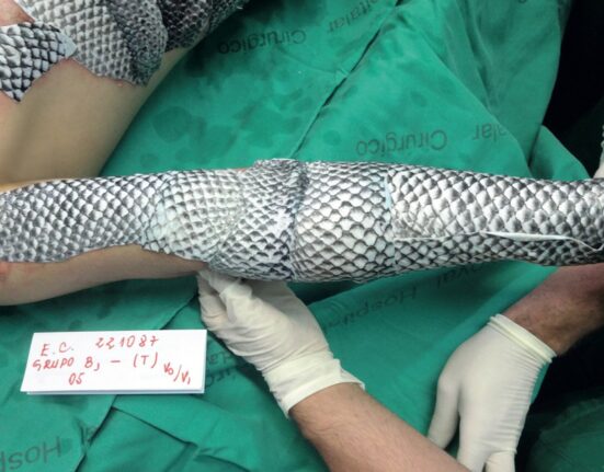 Piel de tilapia para quemaduras: El revolucionario método desarrollado en Brasil para tratar lesiones graves