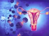 Cáncer ginecológico: cuáles son las señales que no se deben ignorar
